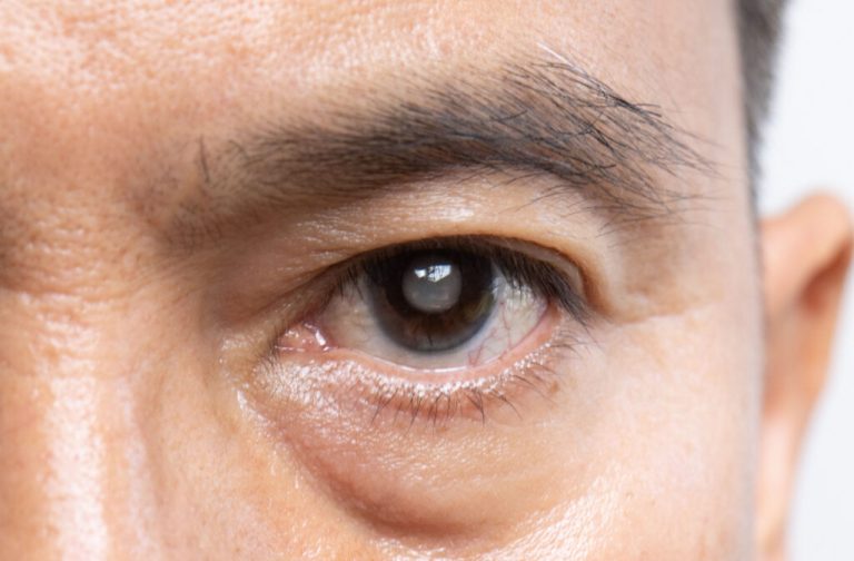 Whats the Difference Between Cataracts Glaucoma Hero 1024x672 1